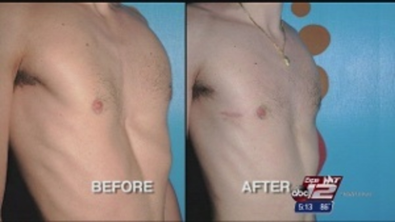 concave chest in teens